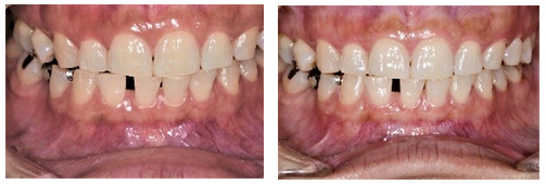 ホワイトニング症例写真