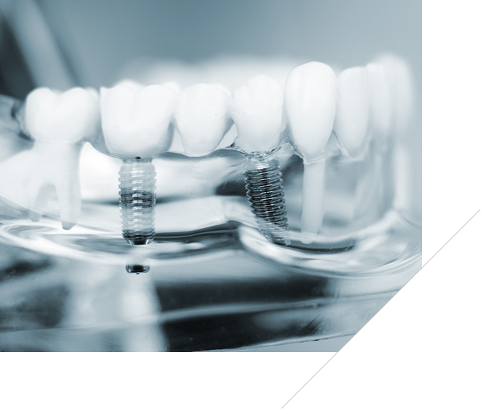 インプラントイメージ画像