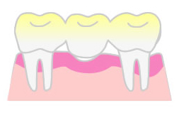 ブリッジイラスト