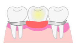 入れ歯イラスト