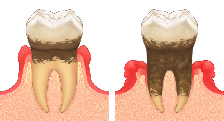 歯周病